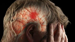 TÜRKİYE’DE HER YIL 250 BİN KİŞİ İNME GEÇİRİYOR 