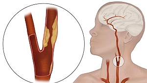 ŞAH DAMAR TIKANIKLIĞINA DİKKAT 