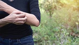 Böcek, sinek derken yazın kaşıntı kabusa dönüşüyor! 