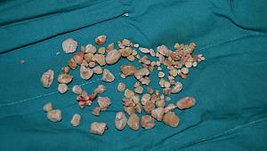 Hastanın Böbreğinden Bir Avuç Taş Çıkartıldı! 