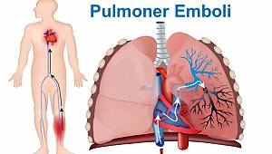 En Tehlikeli 4 Damar Hastalığı 
