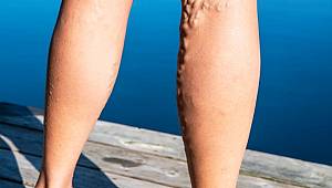 Sıcaklar Artmadan Varis Tedavinizi Yaptırın 