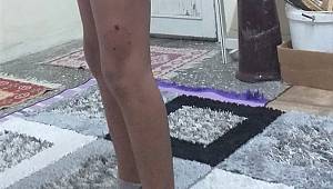 Kahramanmaraş’ta 11 yaşındaki çocuk köpek saldırısına uğradı 