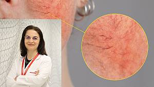 Sıcak havalarda gül hastalığına dikkat! 